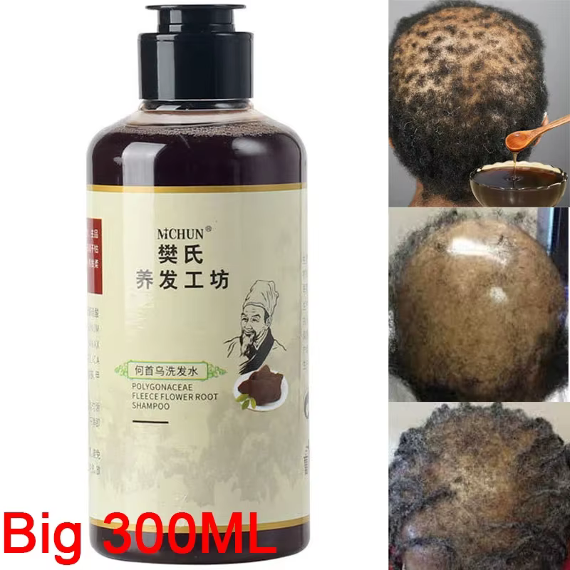 Traitement de Traction d'alopécie pour femmes africaines, produit de croissance des cheveux pour hom