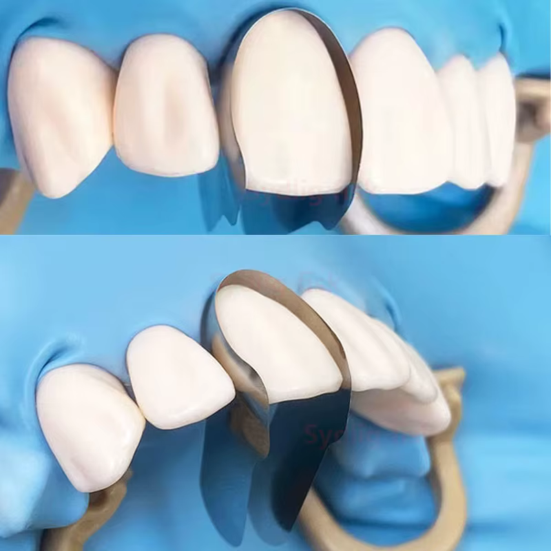 Bandes de matrice métallique antérieure profilées, 30 pièces, système de matrice sectionnelle, double Matrices antérieures, matériaux de dentisterie