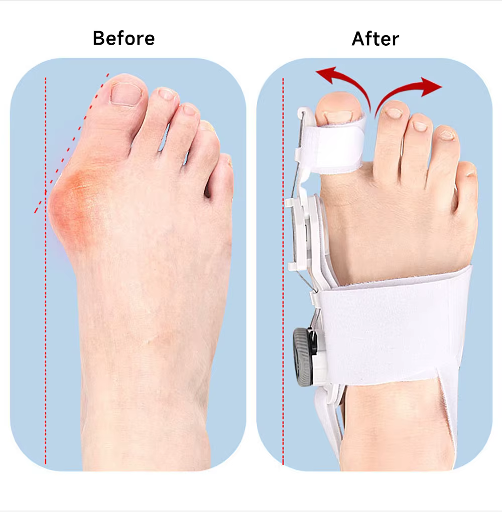Correcteur d'oignon d'orteil, orthèses d'hallux Valgus, séparateur d'orteils réglable, lisseur, ajusteur d'os de pouce, Correction d'orteils